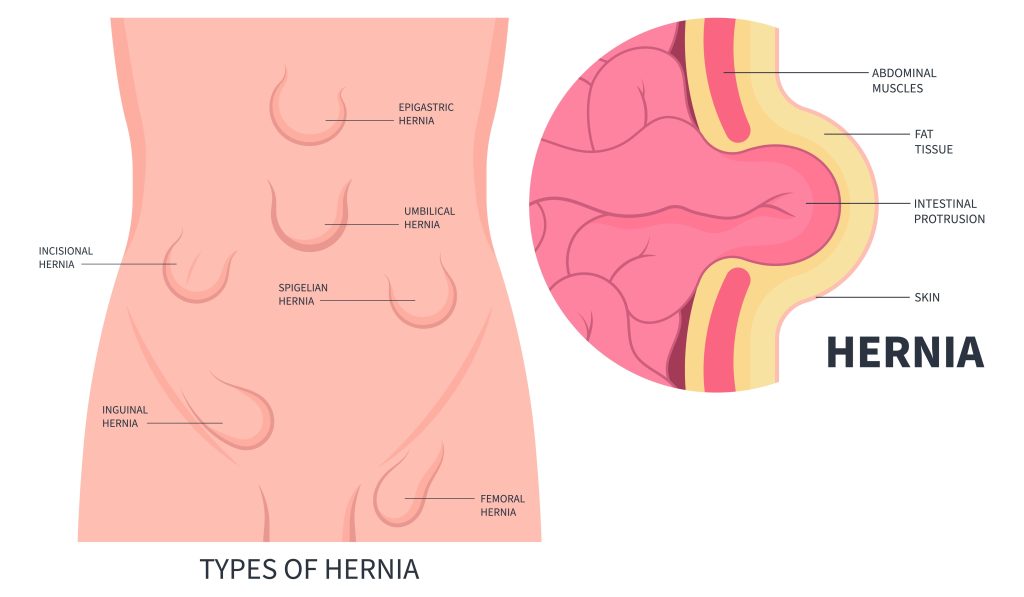 Hernienchirurgie Wien