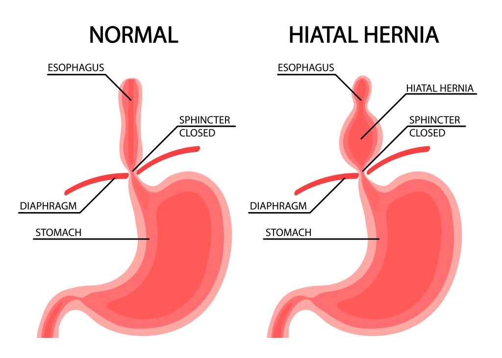 Hernienchirurgie - Vergleich zwischen Zwerchfellbruch und gesundem Zwerchfell